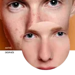 ly_zitcare_resurfacing_cream_7_before-after_1738258969_1024x1024