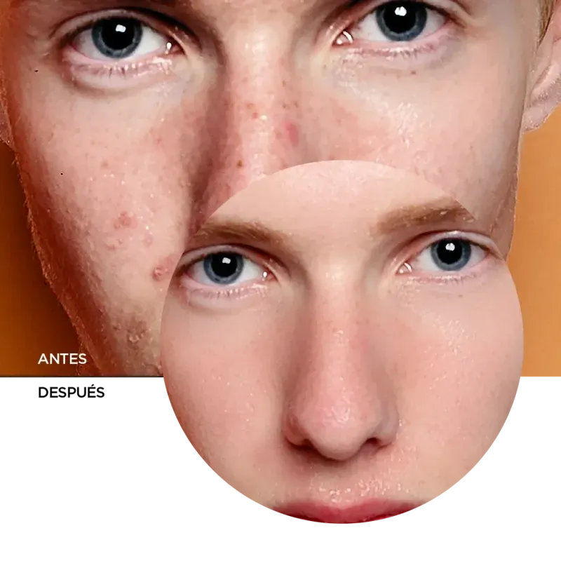 ly_zitcare_resurfacing_cream_7_before-after_1738258969_1024x1024